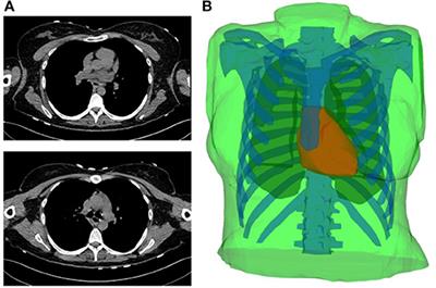 Evaluation of Fifteen Algorithms for the Resolution of the Electrocardiography Imaging Inverse Problem Using ex-vivo and in-silico Data